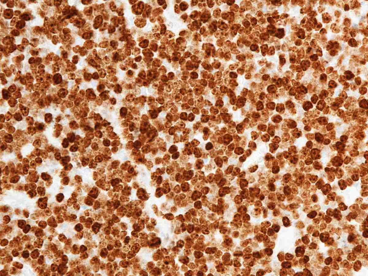 Lymph node 2010 KI67 40X